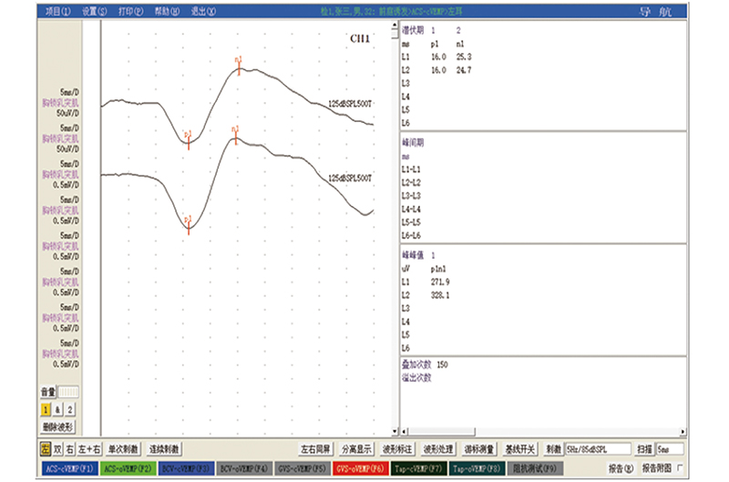 093波形图-前庭诱发2