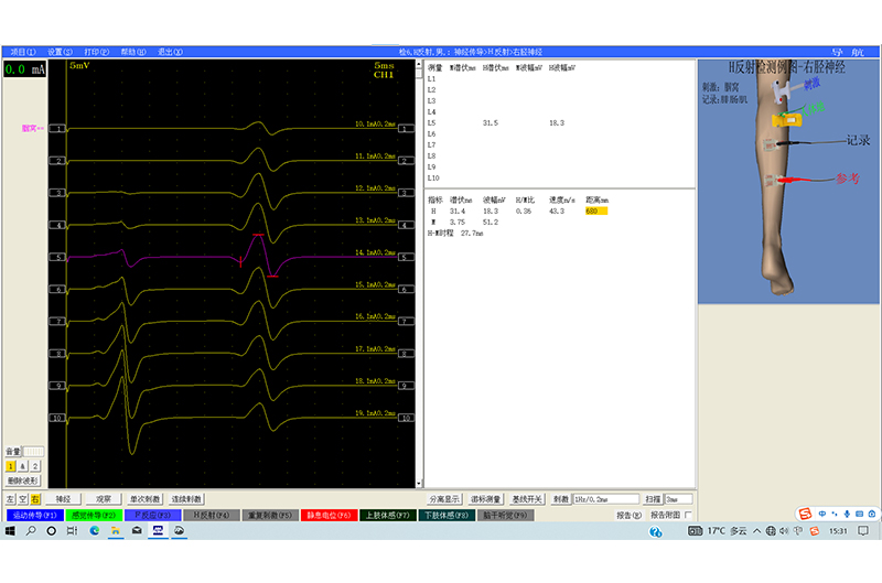 092波形图-神经传导-H反射
