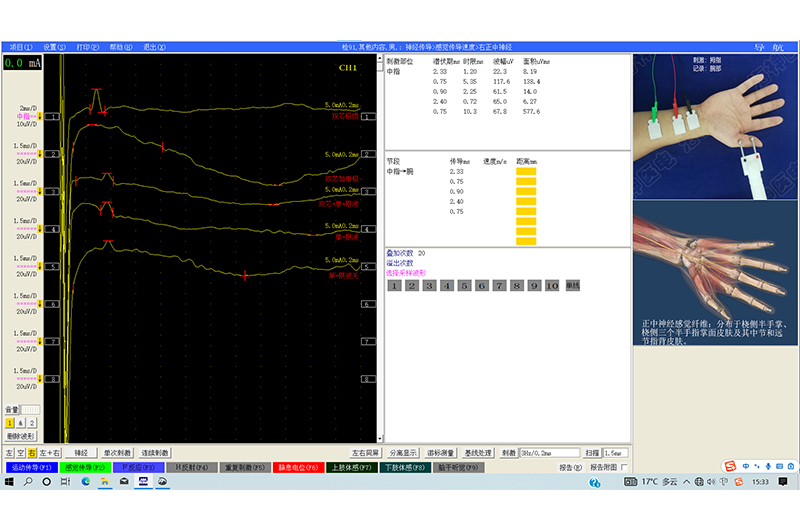 092波形图-神经传导-感觉传导速度