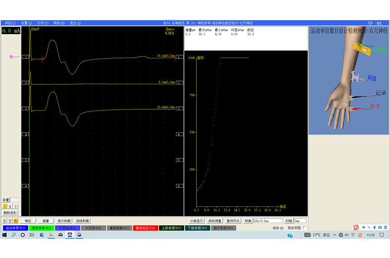 092波形图-神经传导-运动单位数目估计